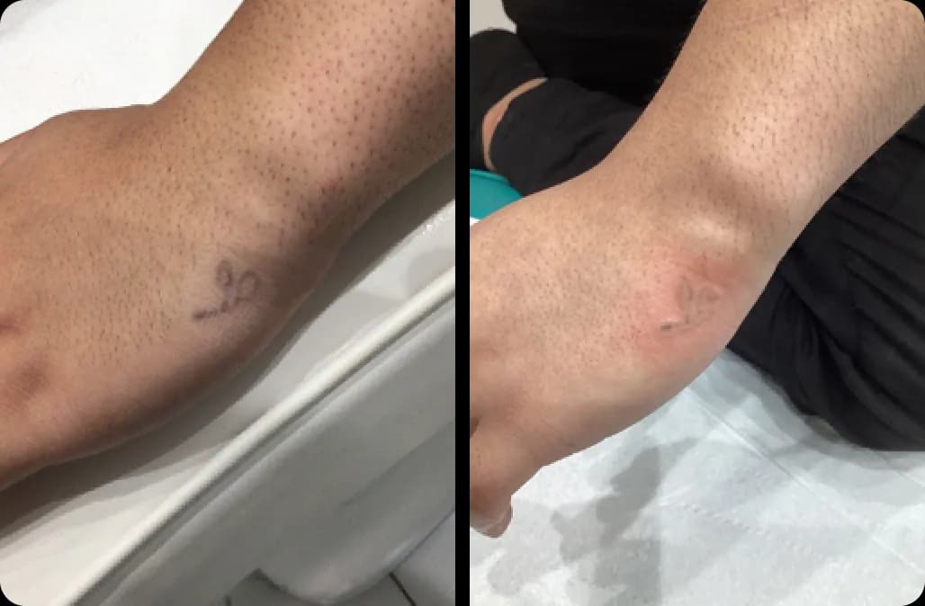 Tattoo Removal