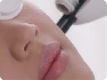 Acne Laser Treatment