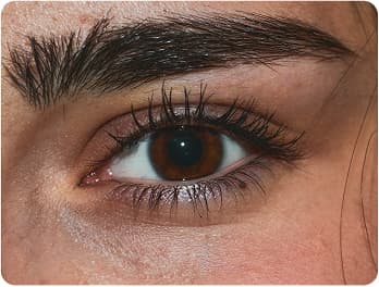 Brow Lift