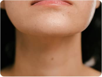 Chin Implants