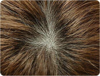 Female Hair Transplant