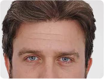 Hair Transplant