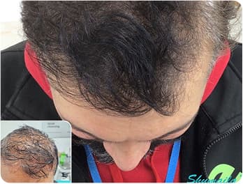 Hairloss Treatments
