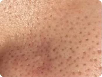 HydraFacial