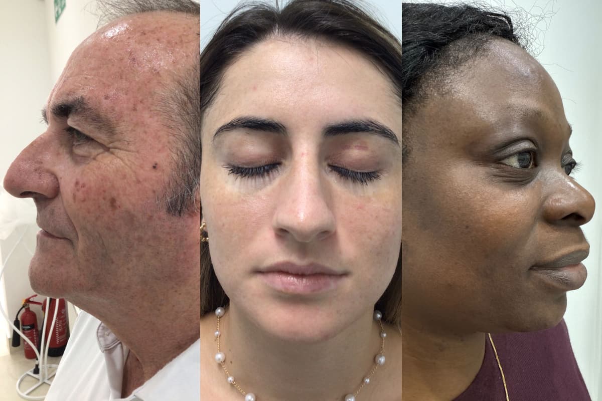 Why Professional Hyperpigmentation Treatment Actually Works