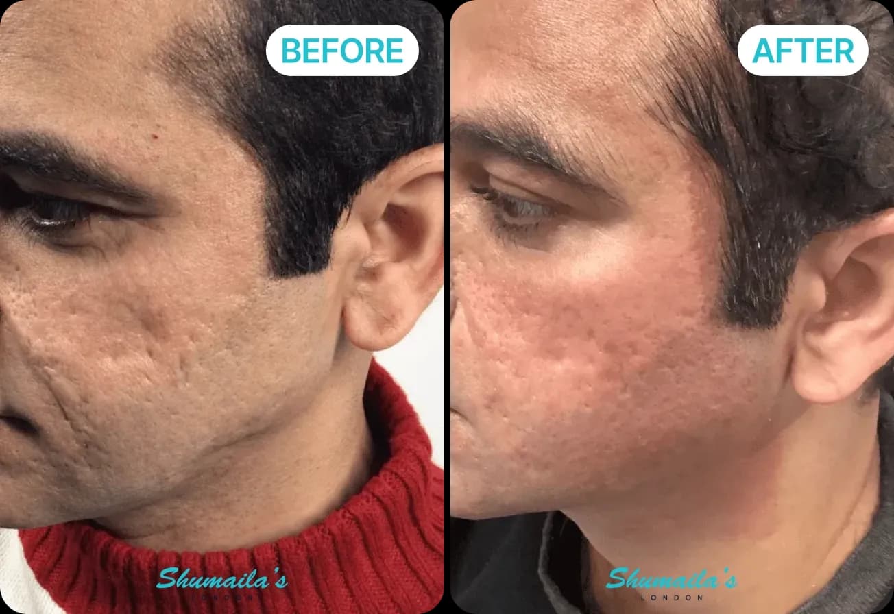 Microneedling