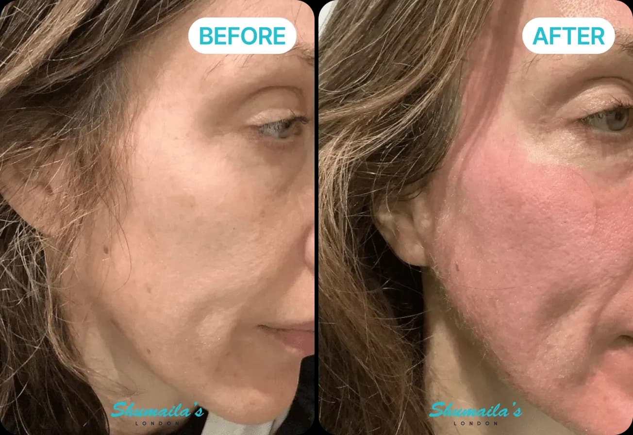 Microneedling