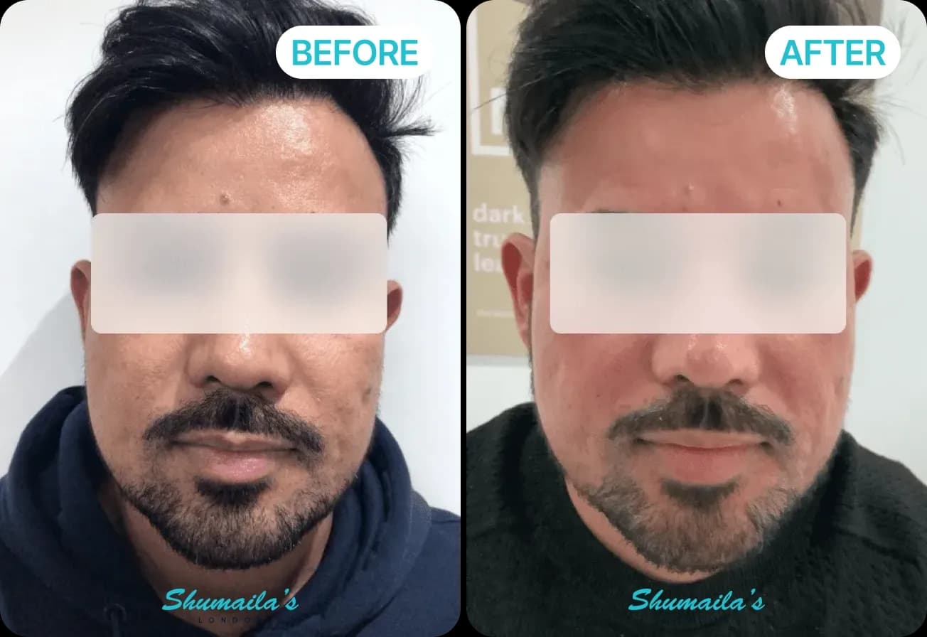 Microneedling