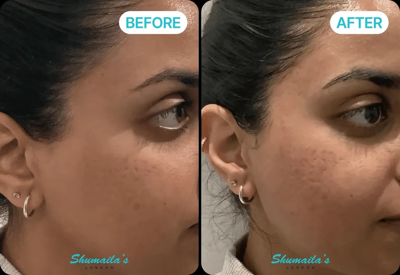 Microneedling