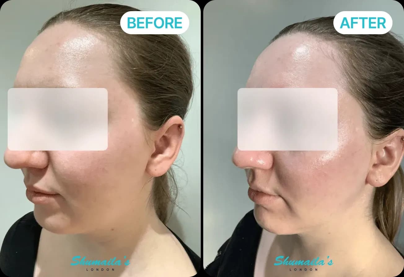 Microneedling