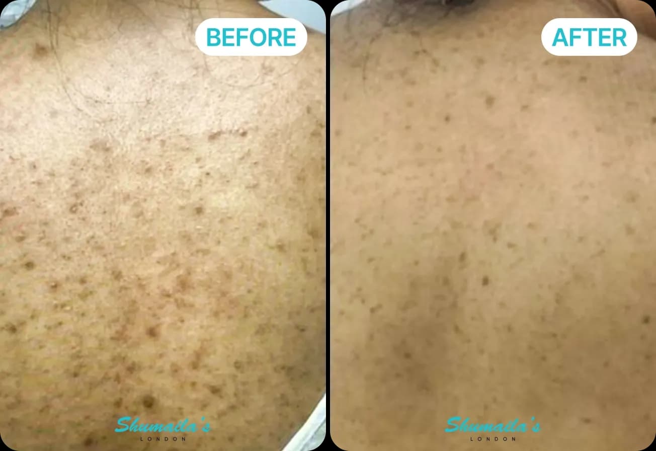 Microneedling