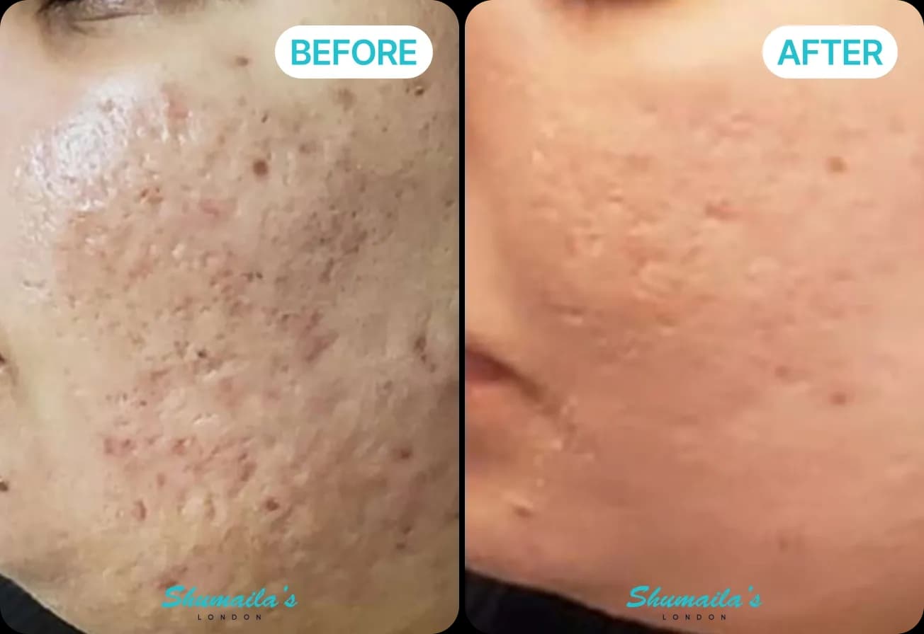 Microneedling