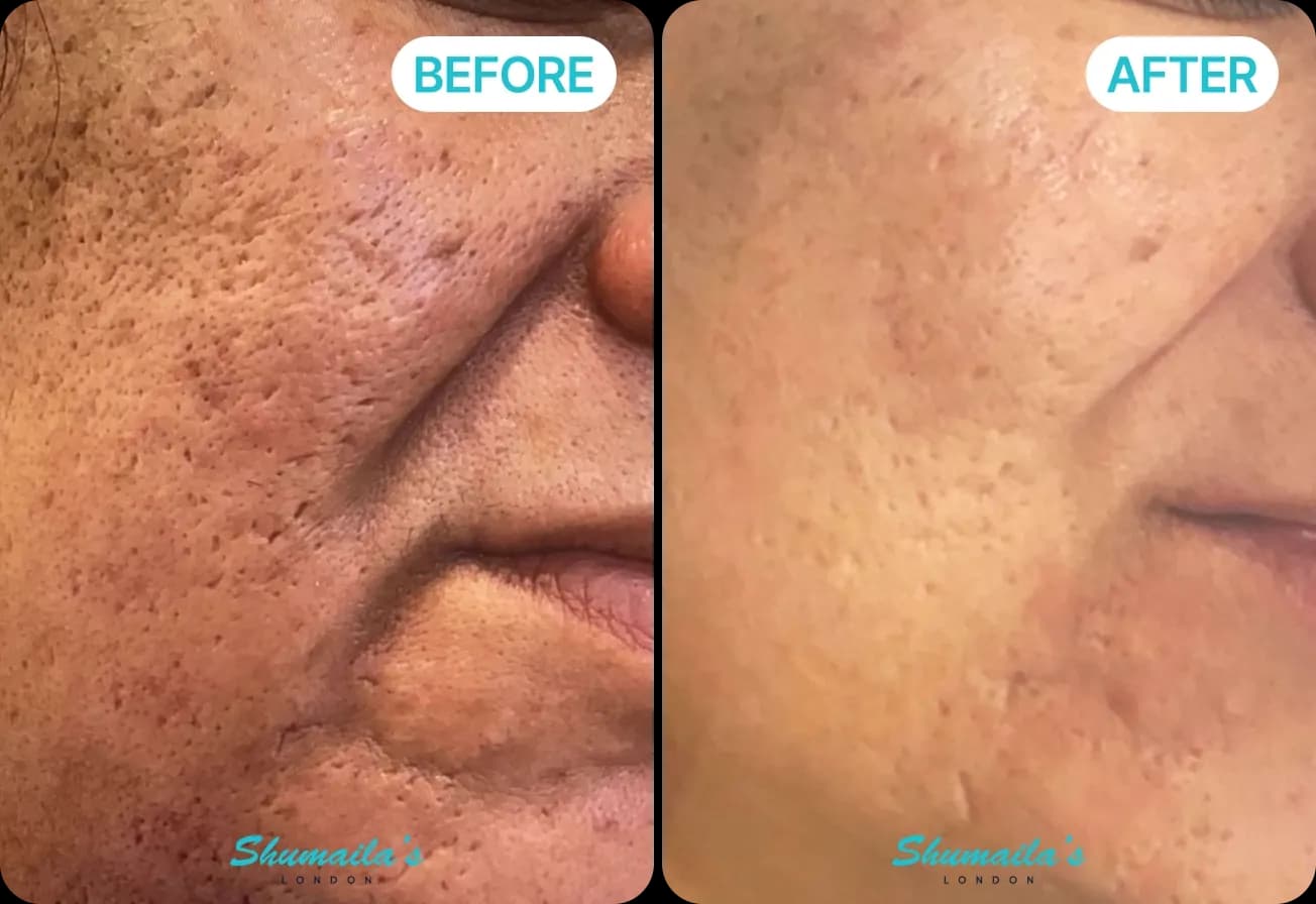 Microneedling