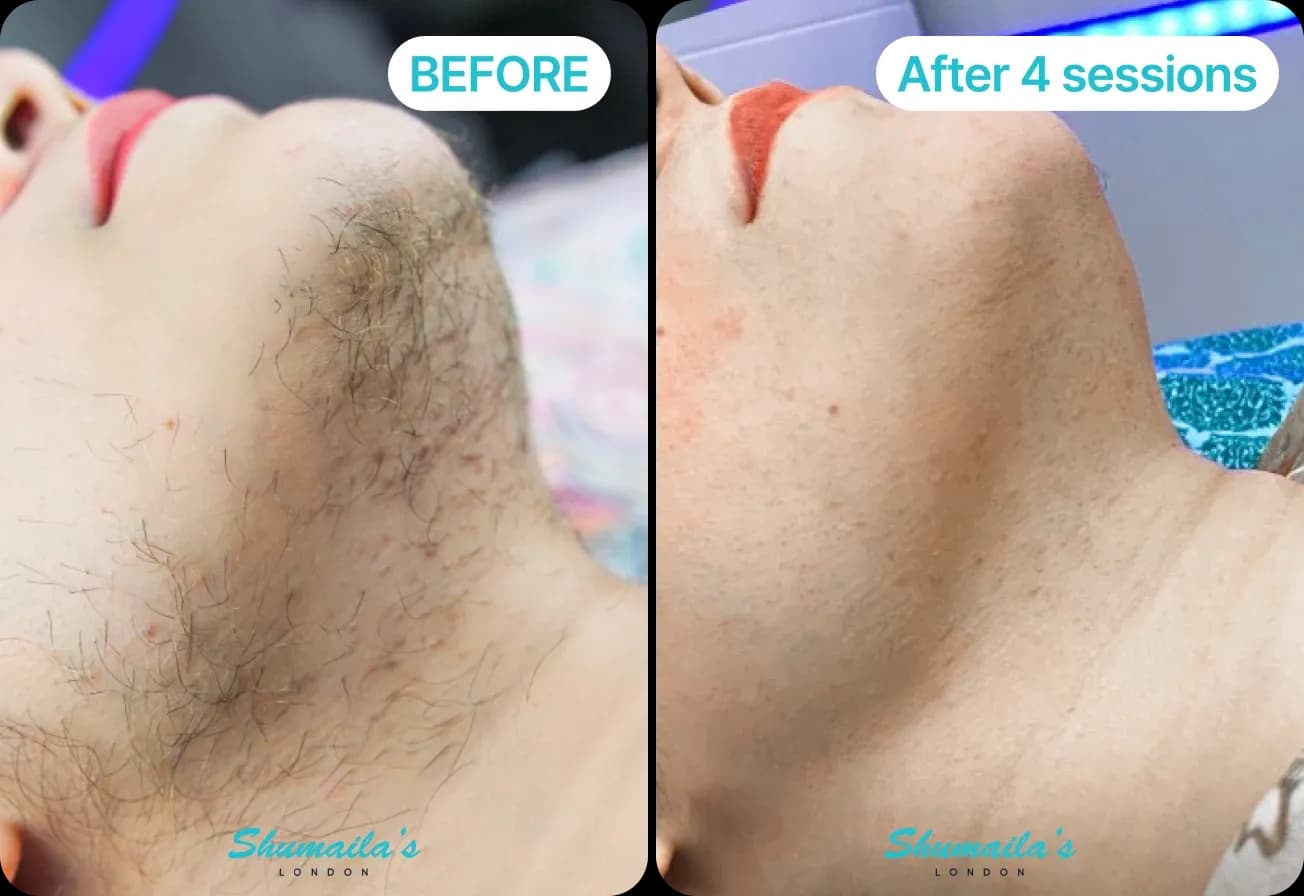 PCOS Laser Hair Removal