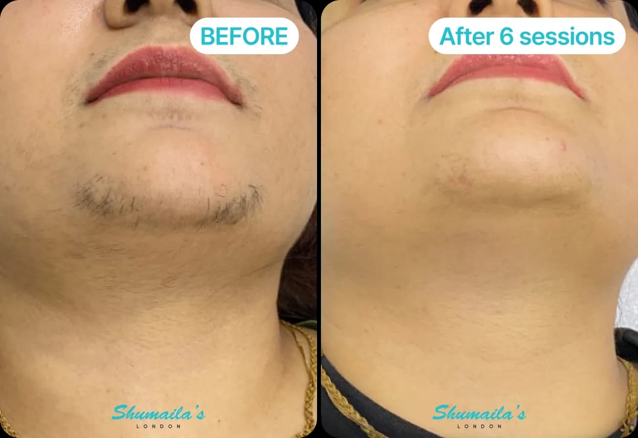 PCOS Laser Hair Removal