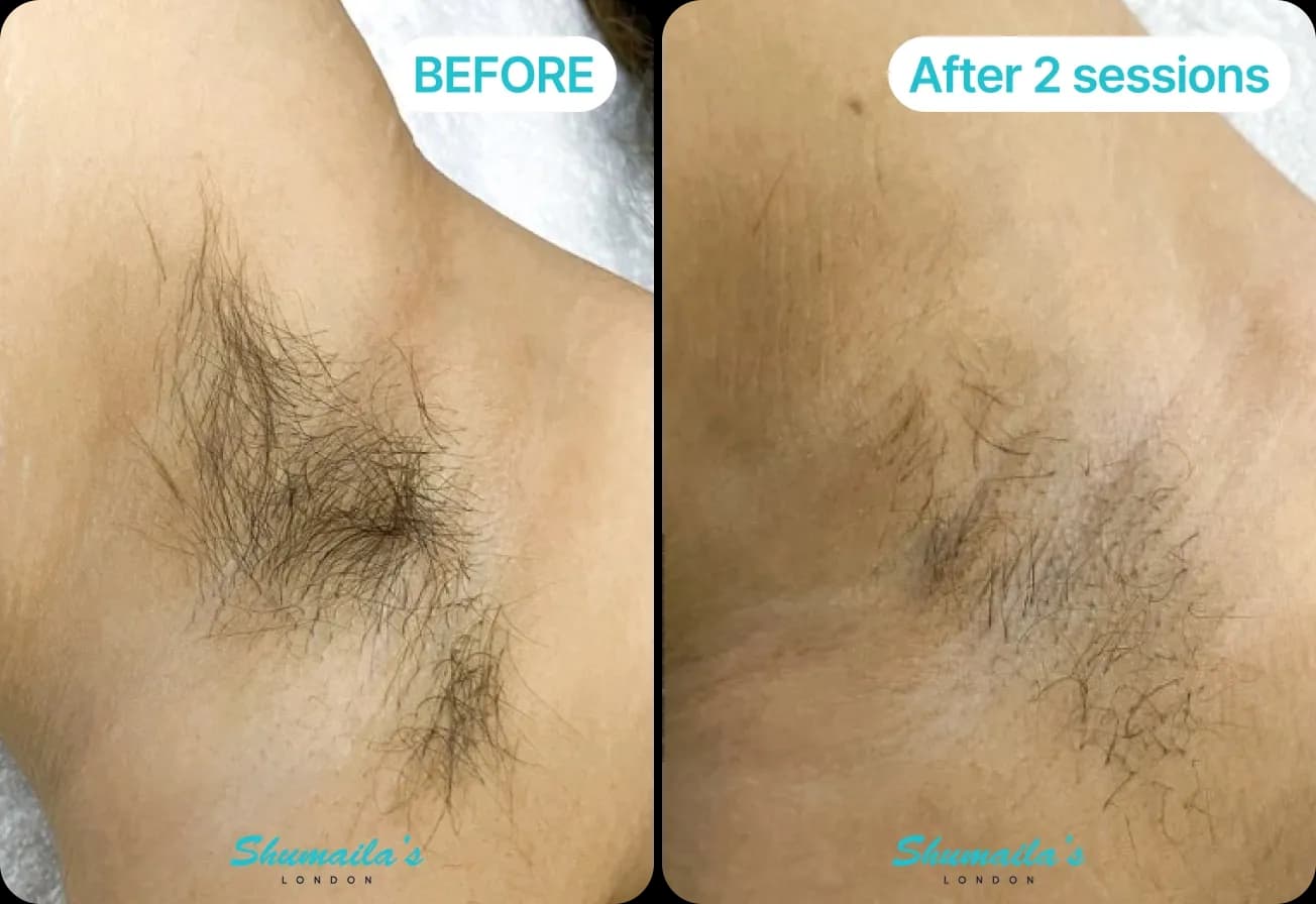 PCOS Laser Hair Removal