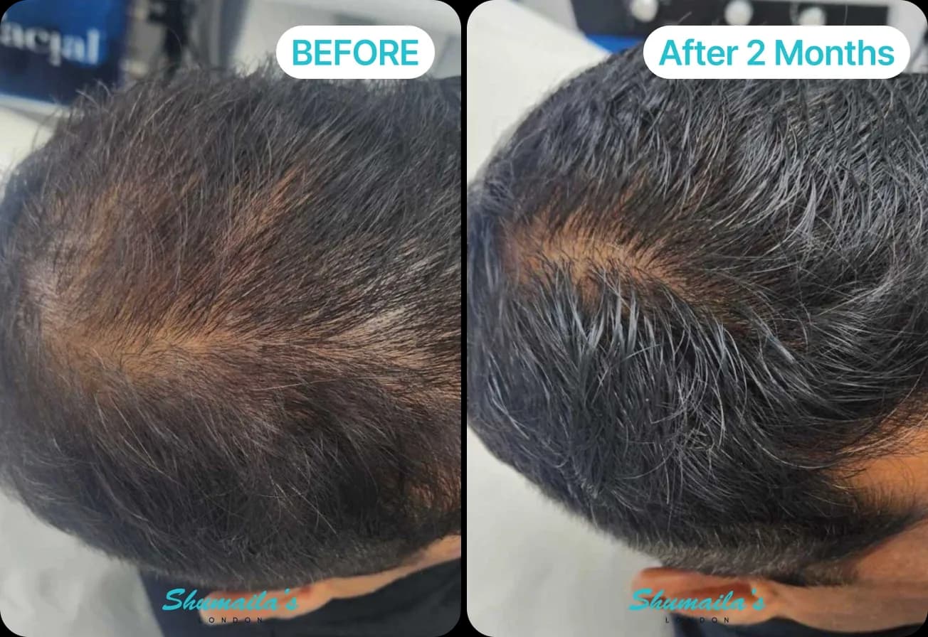Male Hair Loss Treatment