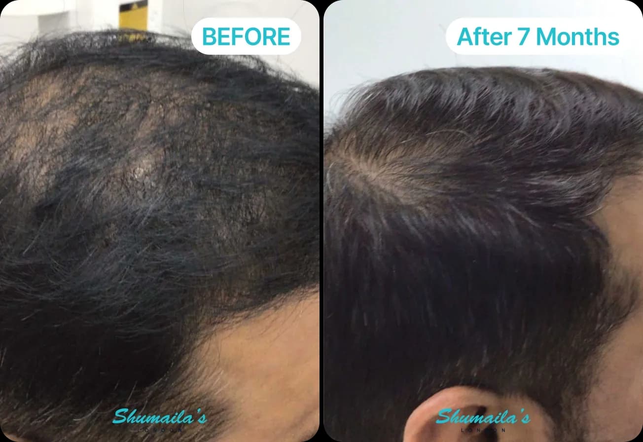Male Hair Loss Treatment