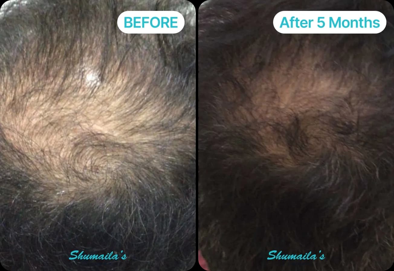 Male Hair Loss Treatment