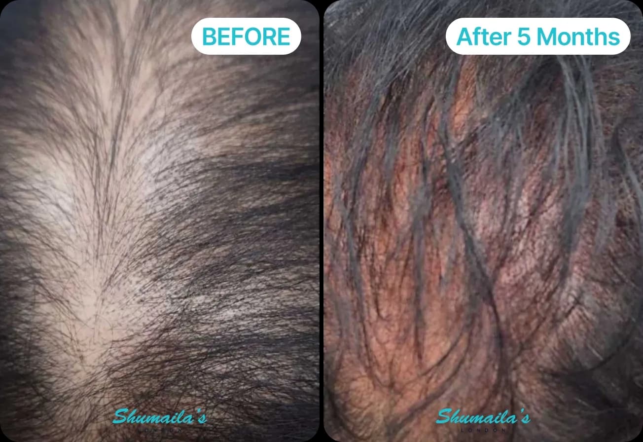 Male Hair Loss Treatment
