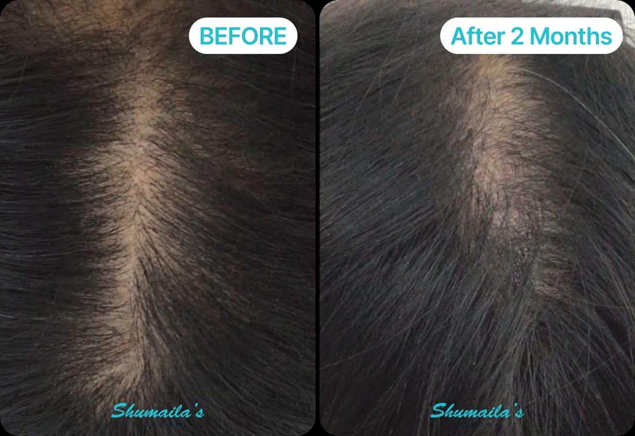 Male Hair Loss Treatment