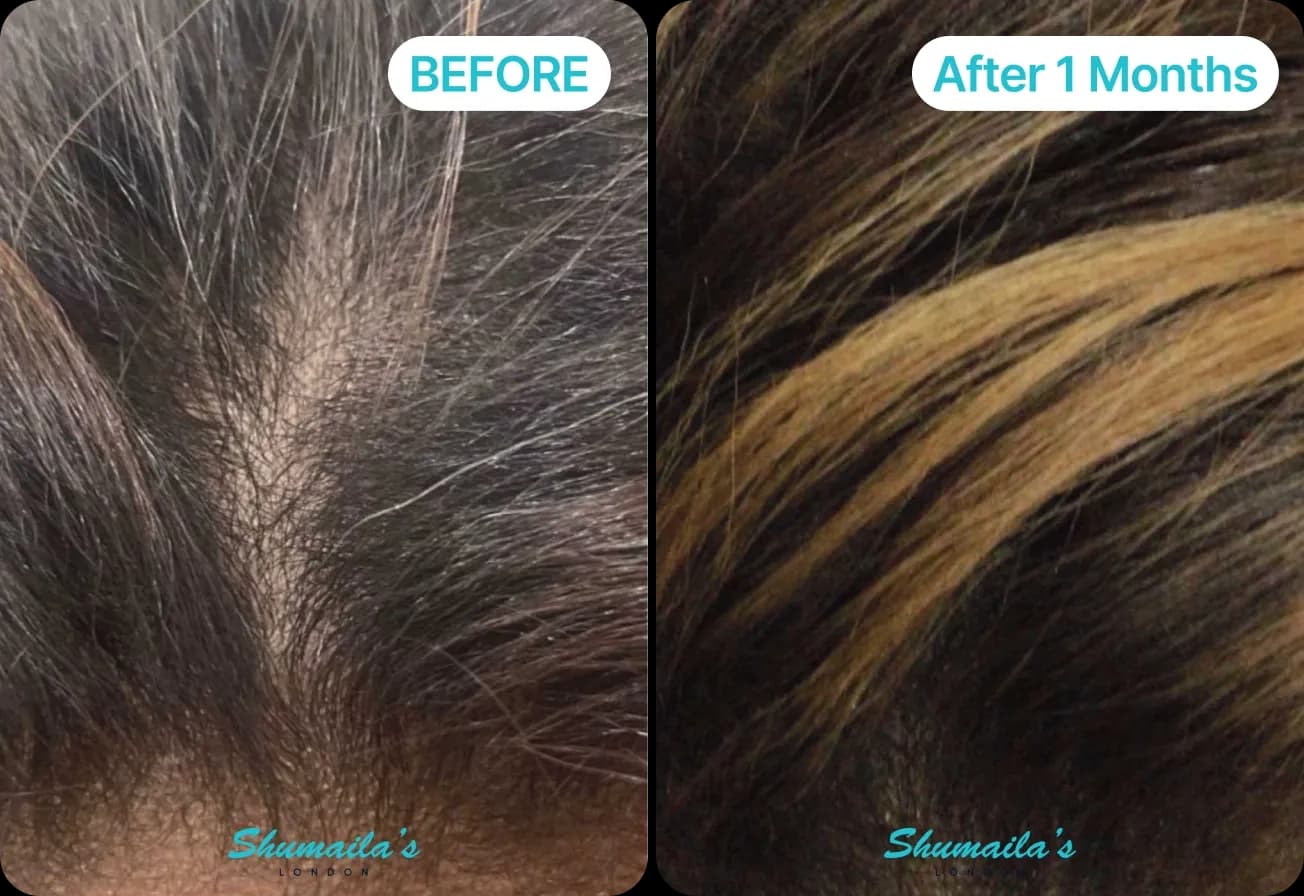 Male Hair Loss Treatment