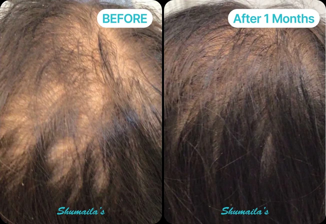 Male Hair Loss Treatment