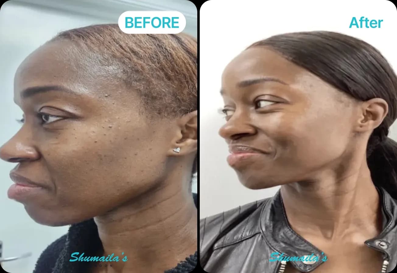 Skin Tag Removal