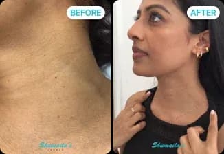 Skin Tag Removal