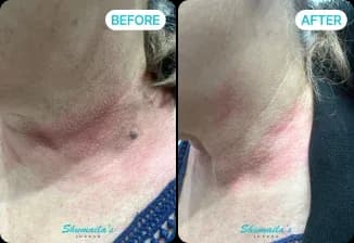 Skin Tag Removal