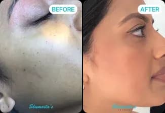 Skin Tag Removal