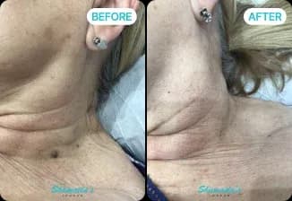 Skin Tag Removal