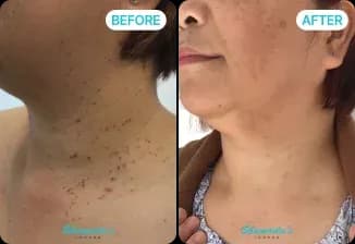 Skin Tag Removal