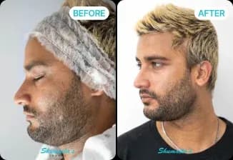 HydraFacial