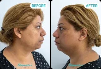 HydraFacial