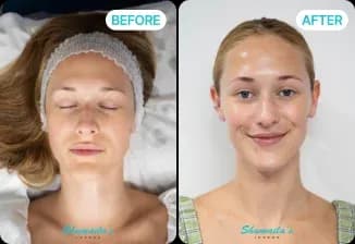 HydraFacial