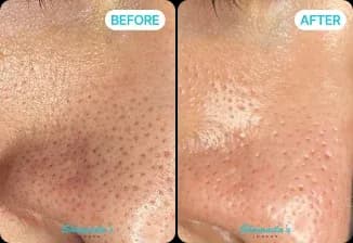 HydraFacial