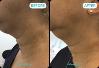 Skin Tag Removal