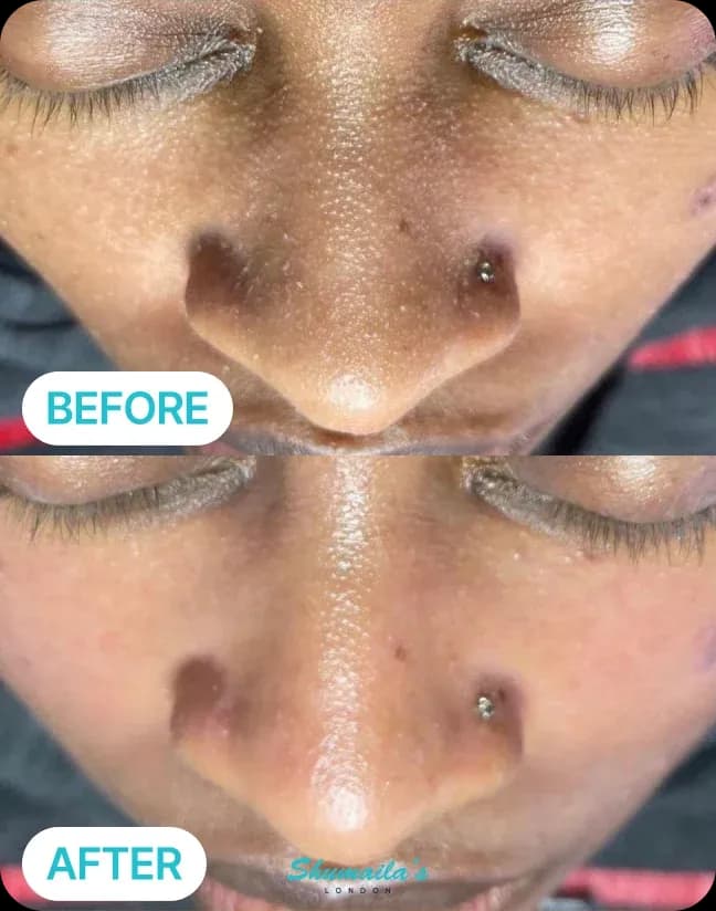 HydraFacial