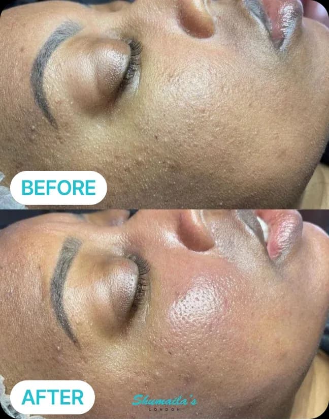HydraFacial