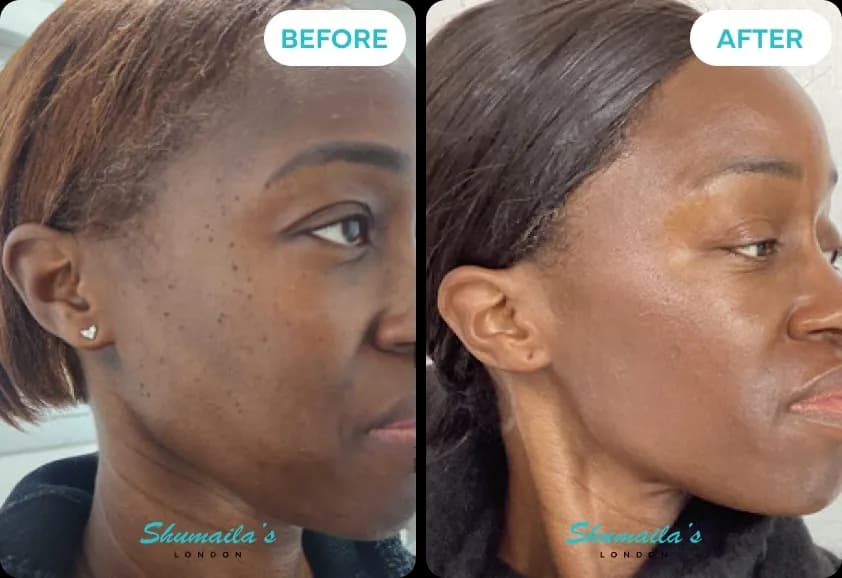 Skin Tag Removal