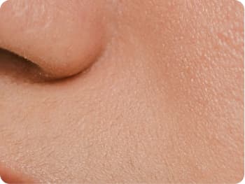 Vampire Facial