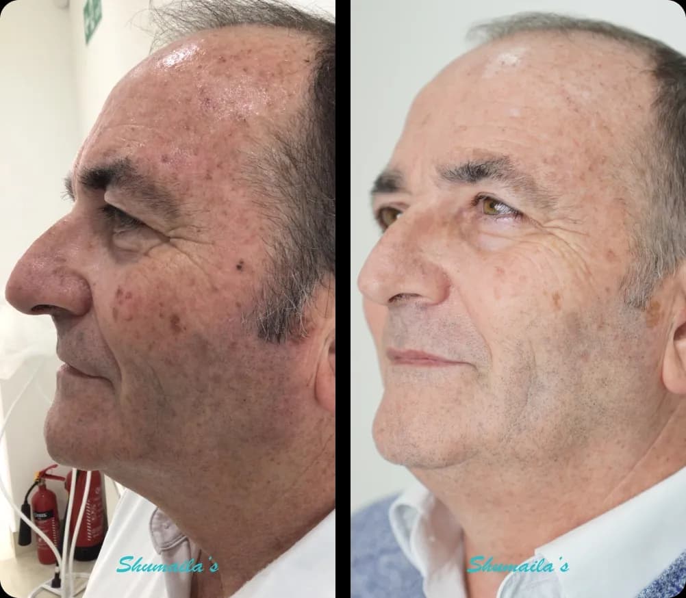 Age Spots