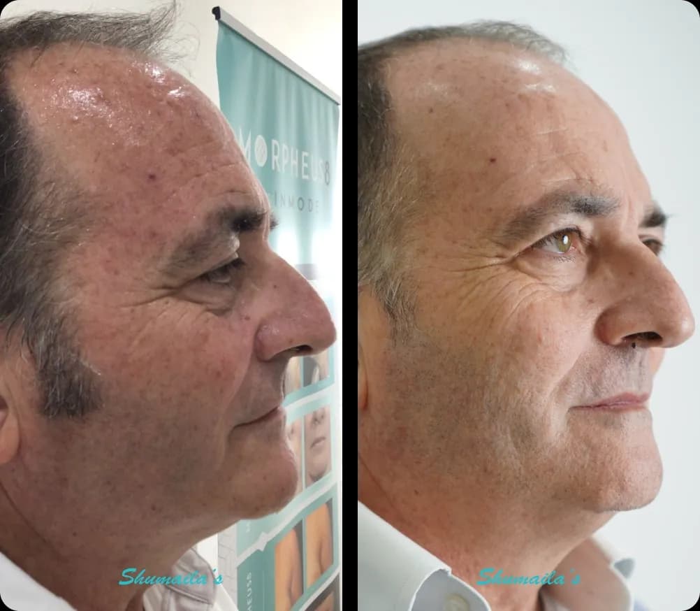 Age Spots
