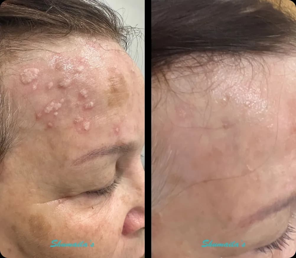 Age Spots