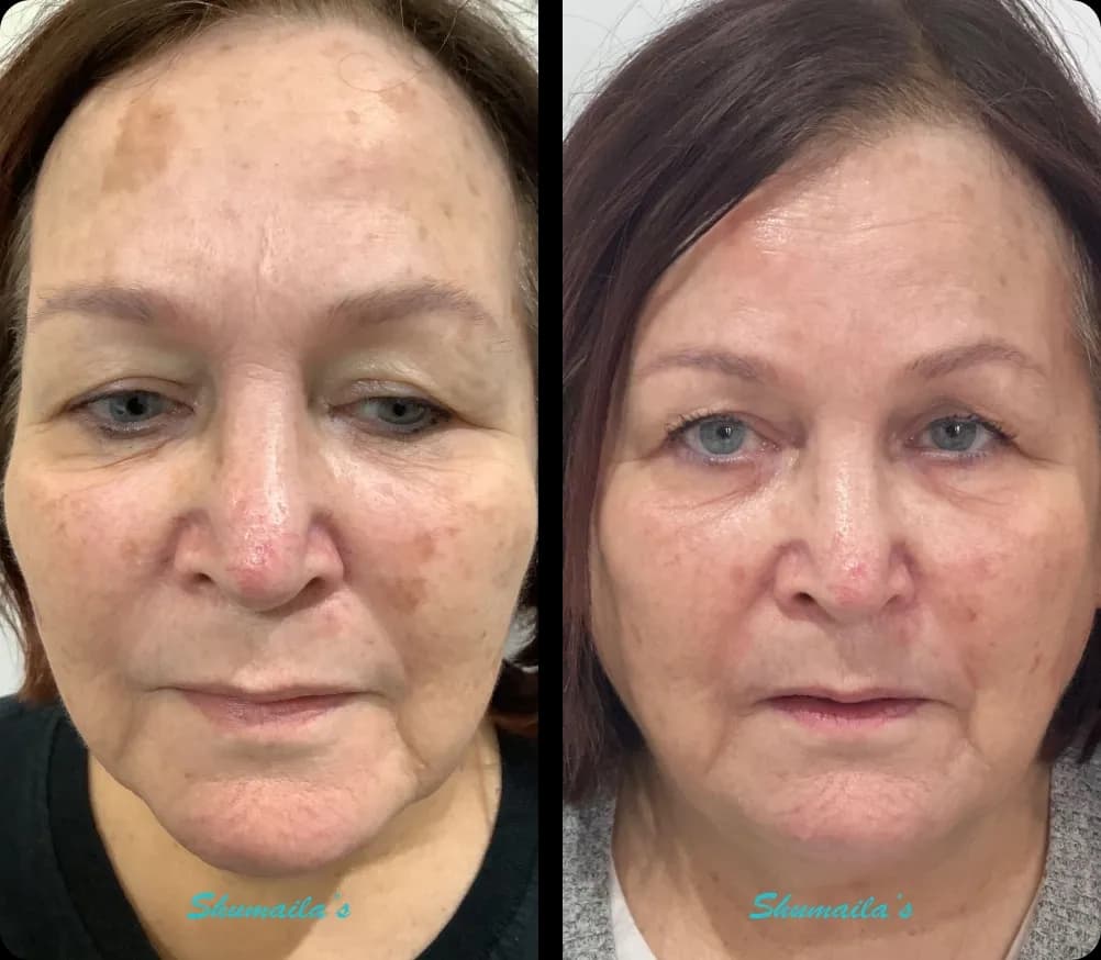 Age Spots
