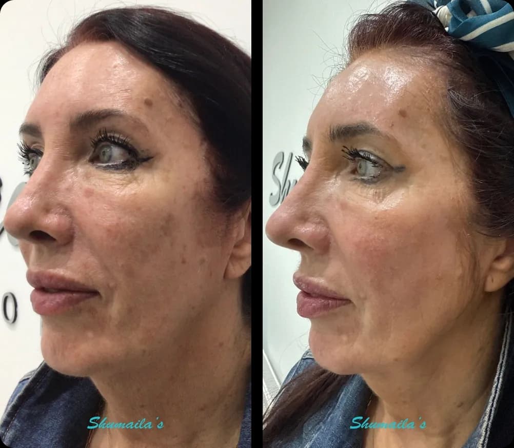 Age Spots