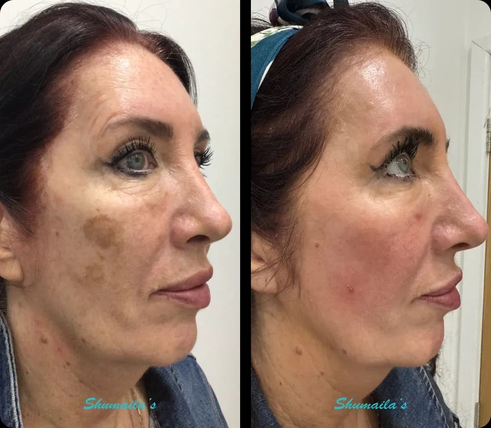 Age Spots