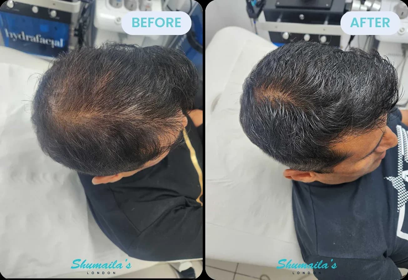 Male Hair Loss Treatment
