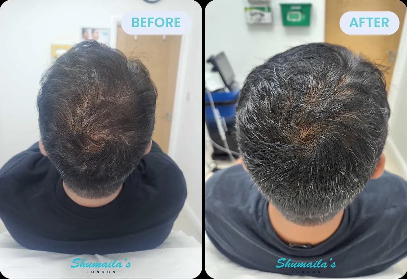 Male Hair Loss Treatment